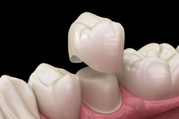 Porcelain Crowns Caps - Seattle SmileWorks - Seattle WA Family Dentist